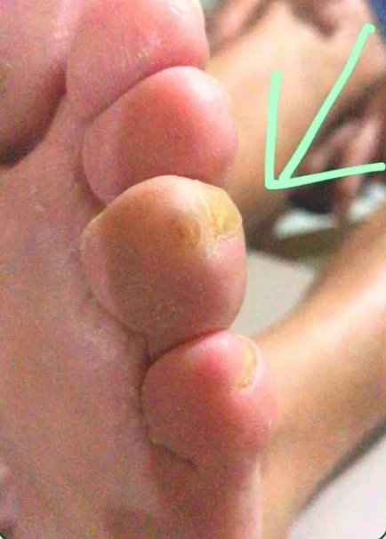 Cuidados com calo no dedo — Depois