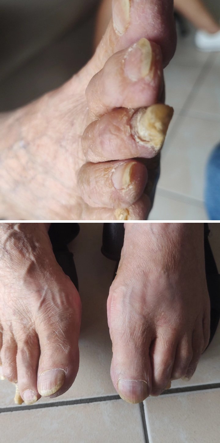 Cuidados nas unhas de pessoa idosa — Antes