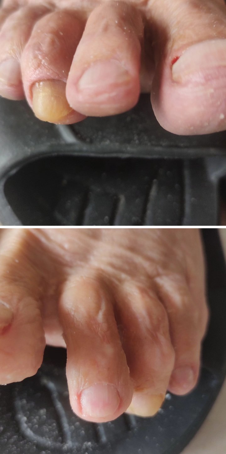 Cuidados nas unhas de pessoa idosa — Depois