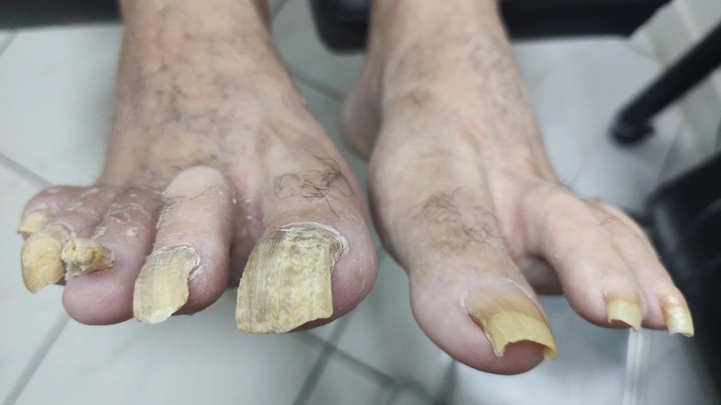 Cuidados em unhas espessas — Antes