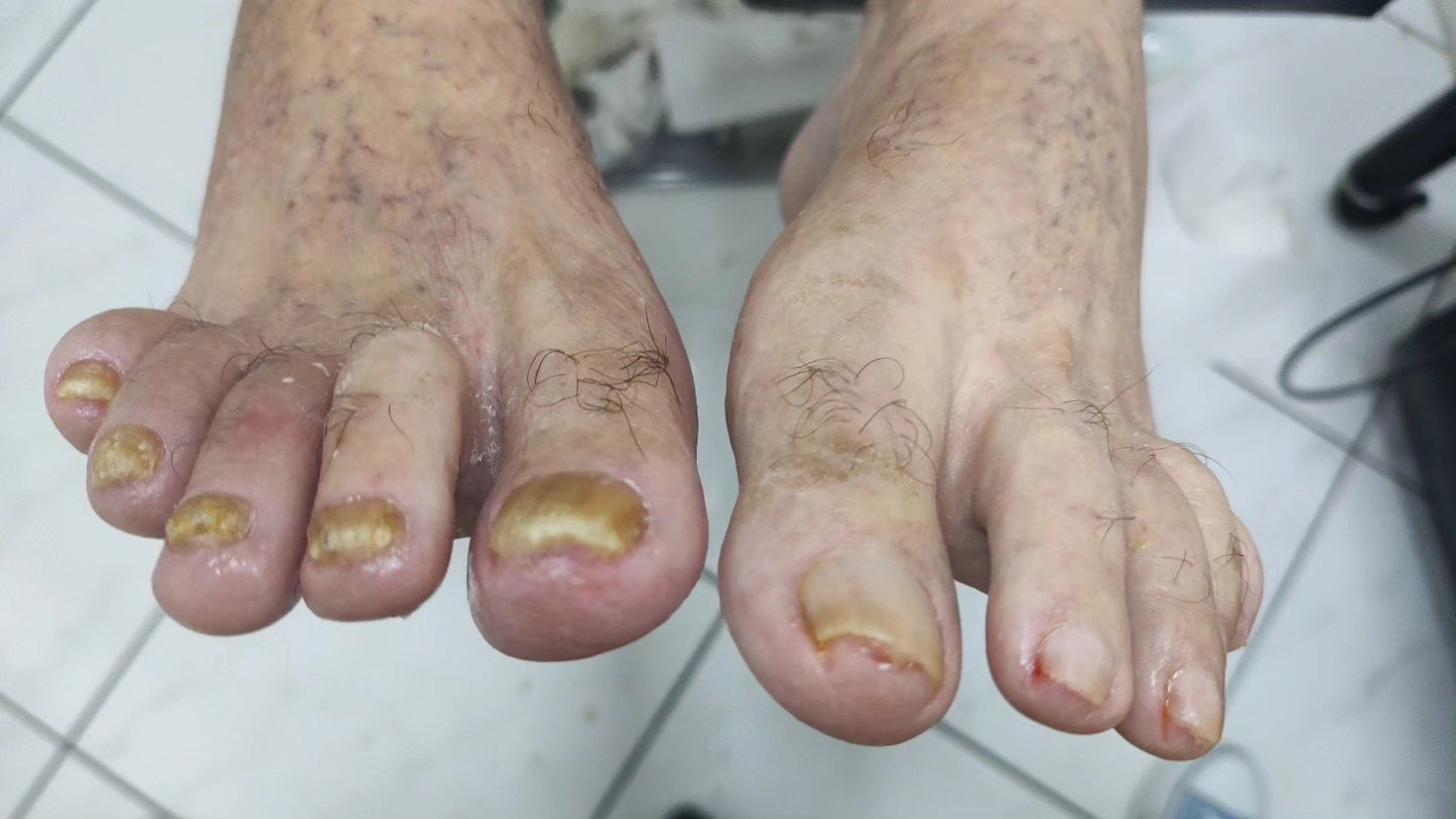 Cuidados em unhas espessas — Depois