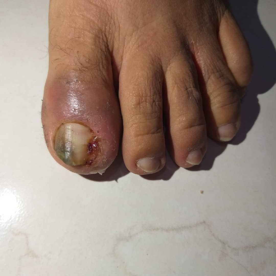 Acompanhamento de cuidados na unha — Depois
